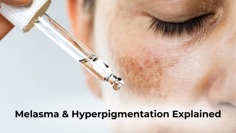 Melasma &Amp; Hyperpigmentation: Causes, Triggers &Amp; Supportive Skincare Routine