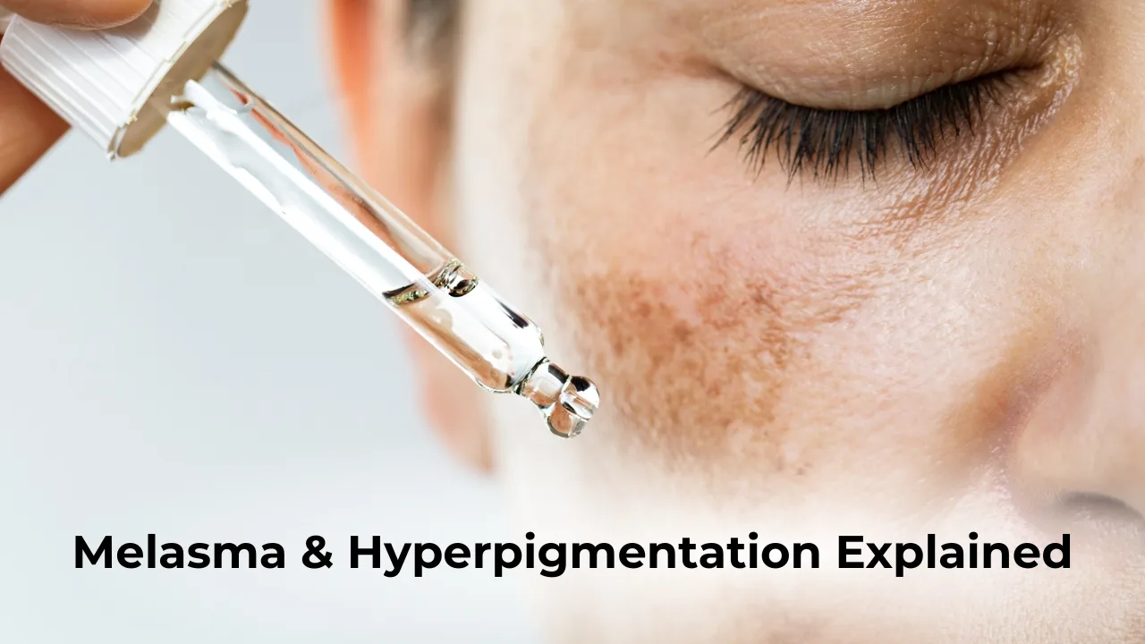 Melasma And Hyperpigmentation Explained, Close-Up Of A Woman’s Face With Dark Patches And A Serum Dropper Applying Skincare Treatment.