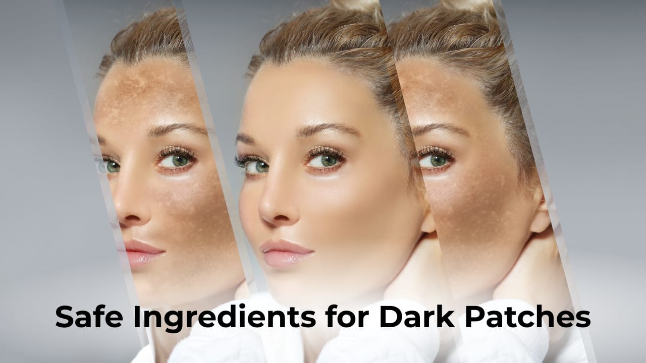 – Impressionz® Beauty, Skincare, Cosmetics &Amp;Amp; Makeup Tools Safe Ingredients For Dark Patches—Woman’s Face Showing Before And After Hyperpigmentation Treatment.