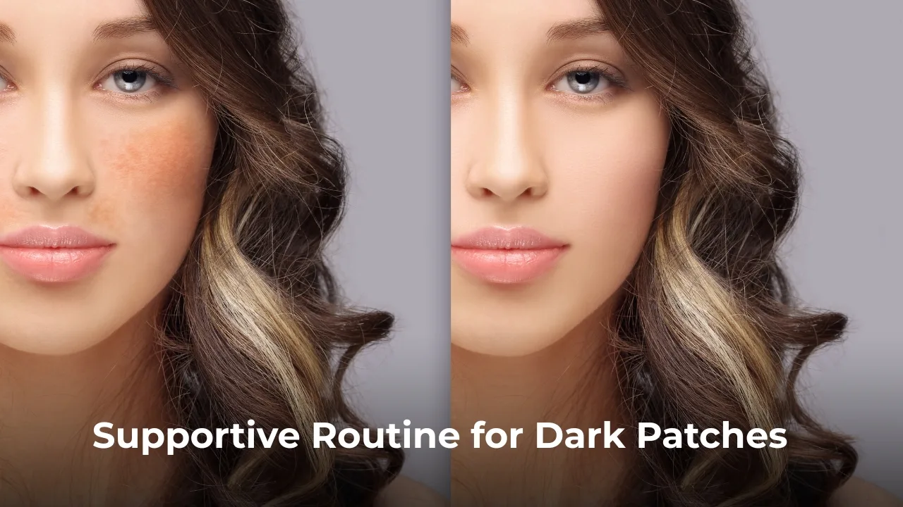 Best Skincare Routine For Melasma And Hyperpigmentation