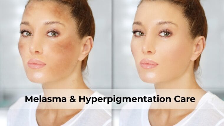 Best Skincare Routine For Melasma &Amp; Hyperpigmentation
