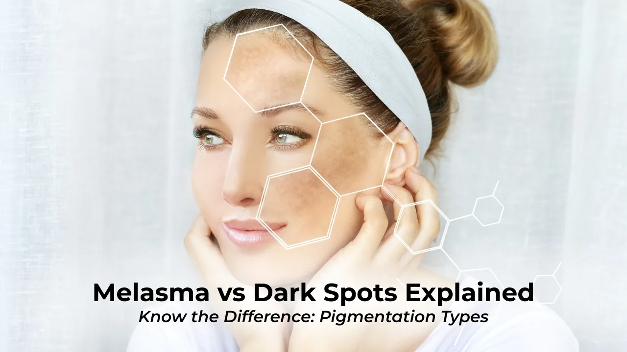 – Impressionz® Beauty, Skincare, Cosmetics &Amp;Amp; Makeup Tools Melasma Vs Dark Spots Explained, Woman With Facial Pigmentation And Hexagon Overlays Showing Different Types Of Skin Discoloration.